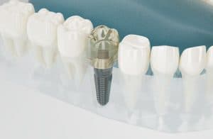 יתרונות של השתלות שיניים